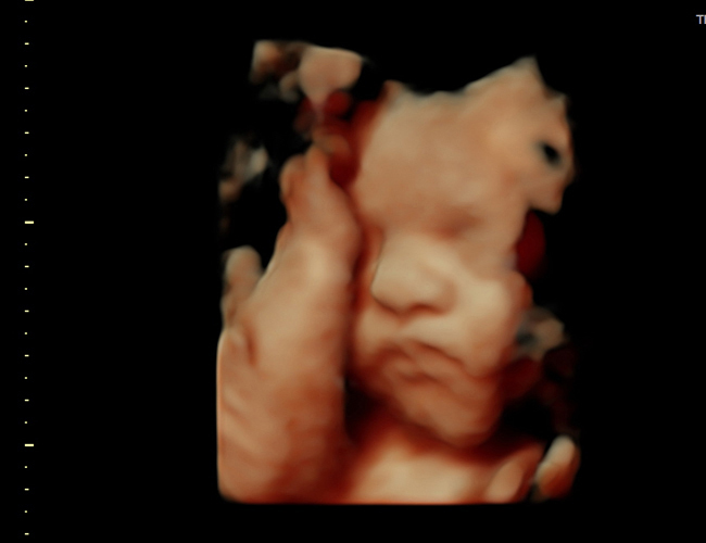 3D ultrasound image at 31 weeks